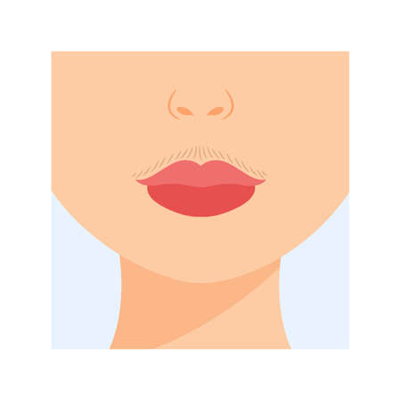 Unwanted Facial Hair. Female Mustache above the Upper Lip. front view. Hormonal Disbalance. Color cartoon style. white background. Vector illustration for Medical and Beauty Design.のイラスト素材