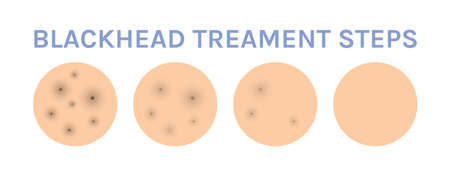 Facial Blackhead on Human Skin. Problem Skin Treatment. step. Dirty and Healthy Clear Skin. before and after. Color Realistic style. white background. Vector illustration for Beauty and Medical Designのイラスト素材