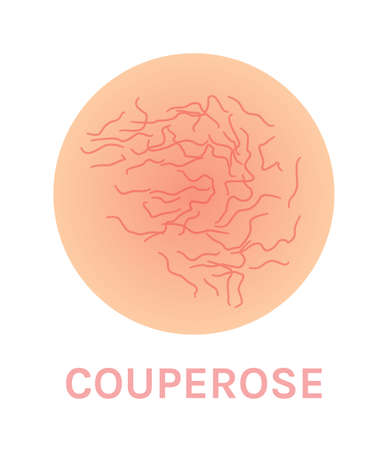 Couperose and Rosacea. Dermatological Disease. Red Capillaries on the Skin. Vector illustration for Medical Design and Education.のイラスト素材