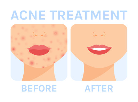 Pimples on a Woman Face. Treatment of Acne on Cheeks and Chin. before and after. Healthy Clear Skin. smile. Color cartoon style. white background. Vector illustration for Medical and Beauty Design.のイラスト素材