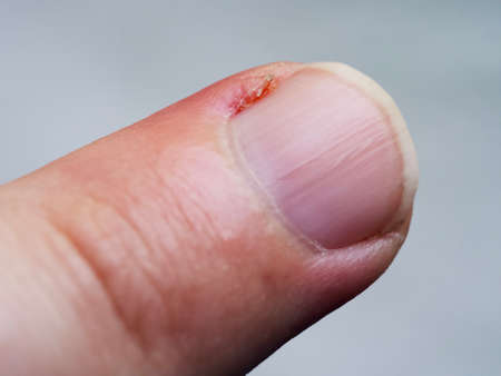 Inflamed cuticle on the finger. Damaged part of the finger, close-up.の写真素材