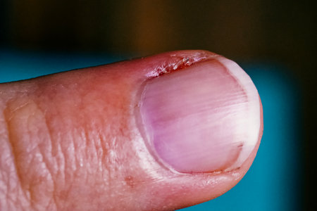 The image shows a finger with a visible, healing wound.の写真素材