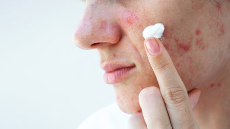 young woman applies acne cream on face with pimples and blackheads. Teenage girl with problematic skin in close-up on an isolated white backgroundの写真素材