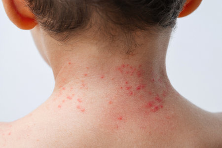 Red rashes from Coxsackie virus on a child's back on a white background. Close-up of rash on child's...