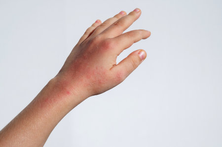 Chicken pox red rash spots on child skin close-up. Coxsackie virus on hand of baby