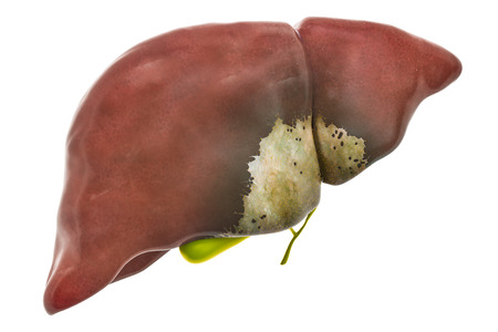 Liver or gallbladder disease concept, 3D rendering isolated on white backgroundの写真素材