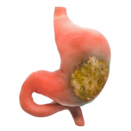 Stomach disease concept, 3D rendering isolated on white backgroundの写真素材