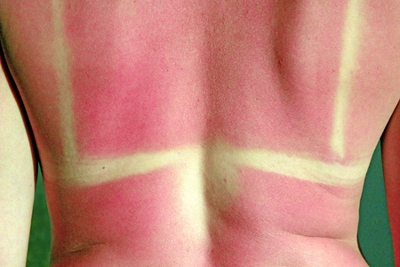Human back burnt after sunburn. Scald of the back by sun's beamsの写真素材