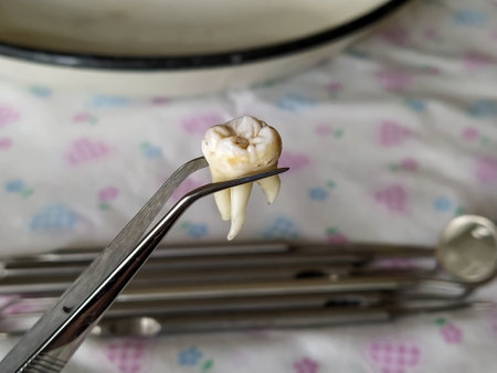 Extracted tooth in tweezers on the background of the dental instruments close-up