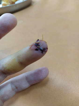 Injured finger with a surgical suture, vertical pictureの写真素材