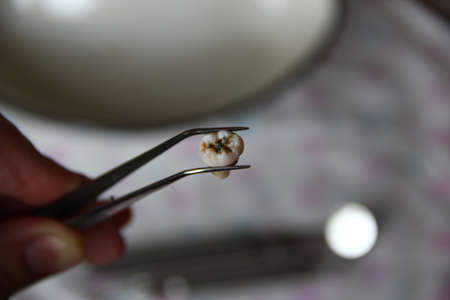 Extracted tooth in tweezers against the background of dental instruments