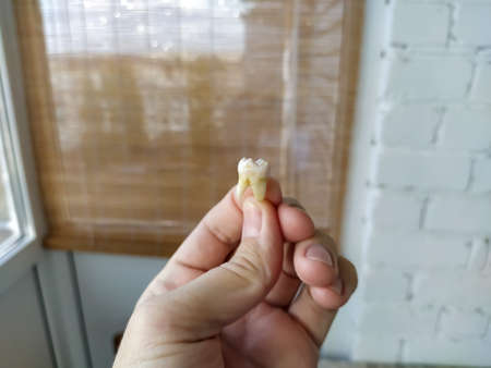 Man hand holds the extracted tooth