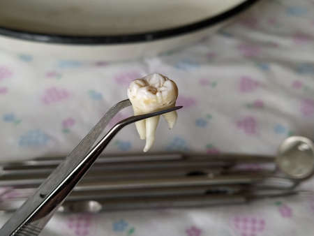 Extracted tooth in tweezers on the background of the dental instruments close-upの写真素材