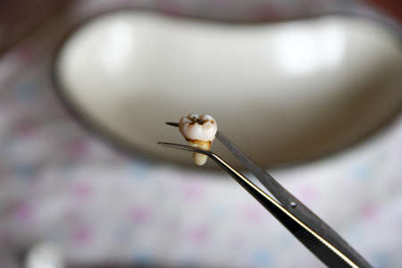 Extracted molar tooth in the tweezers