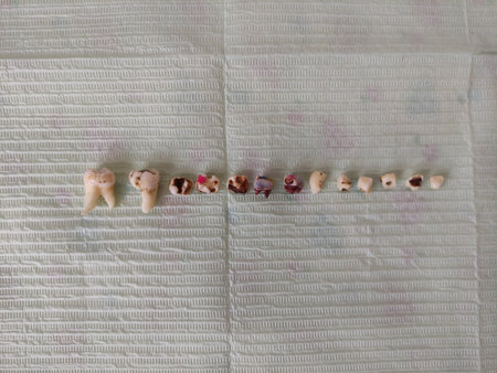 Row of extracted teeth on a napkin