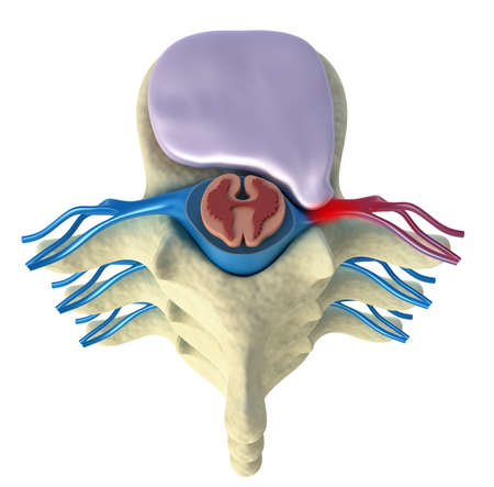 Prolapse of intervertebral disc  Top view