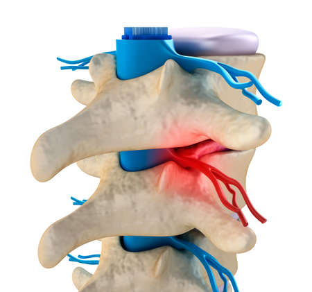 Spinal cord under pressure of bulging disc