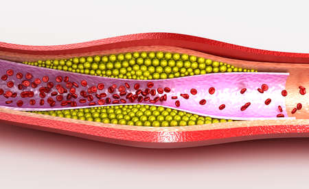 Cholesterol plaque in blood vessel, illustrationの写真素材