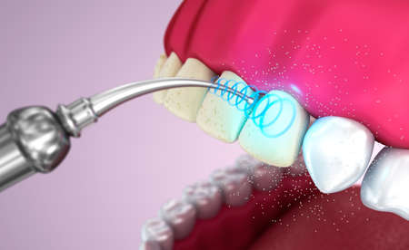 Teeth whitening, Medically accurate 3D illustration