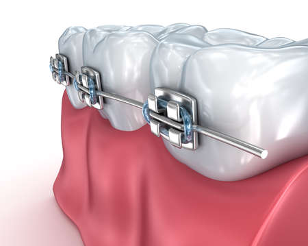 Teeth with braces isolated on white. Medically accurate 3D illustrationの写真素材