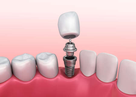 Tooth implant instalation process, Medically accurate 3D illustration white style