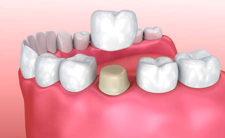 Dental crown installation process, Medically accurate 3d illustrationの写真素材