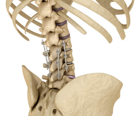 Spinal fixation system - titanium bracket. Medically accurate tooth 3D illustration