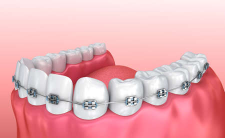 Teeth with braces isolated on white. Medically accurate 3D illustrationの写真素材