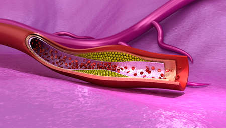 Cholesterol plaque in blood vessel, Medically accurate 3D illustrationの写真素材