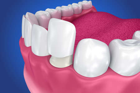 Dental Veneers: Porcelain Veneer installation Procedure. 3D illustrationの写真素材