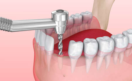 Tooth implant installation process, Medically accurate 3D illustrationの写真素材