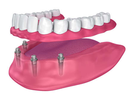 Overdenture to be sealed on implants - ball attachments. 3D illustrationの写真素材