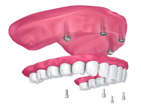 Overdenture to be sealed on implants attachments. 3D illustrationの写真素材