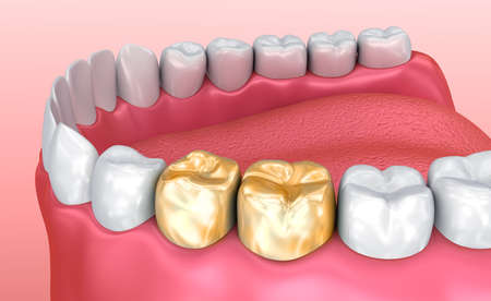 Healthy teeth and golden crowns, Medically accurate tooth 3D illustrationの写真素材