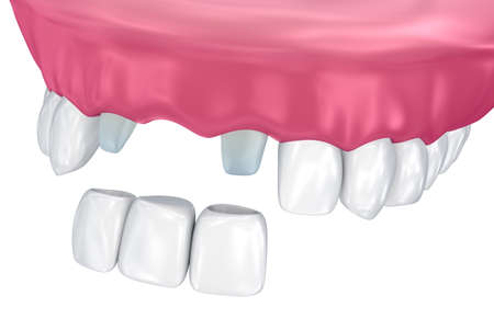 Tooth supported fixed bridge. Medically accurate 3D illustration