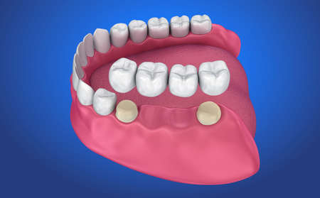 Tooth supported fixed bridge. Medically accurate 3D illustration