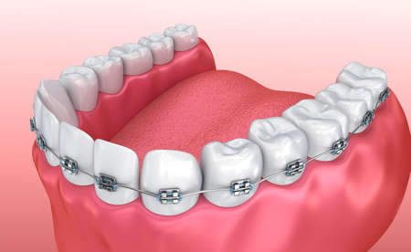 Teeth with braces isolated on white. Medically accurate 3D illustration