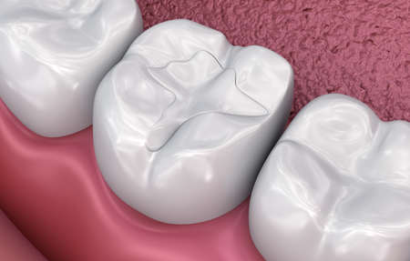 Dental fissure fillings, Medically accurate 3D illustrationの写真素材