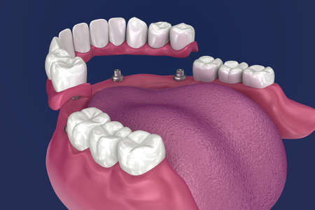 Overdenture to be seated on 4 implants - ball attachments. 3D illustration