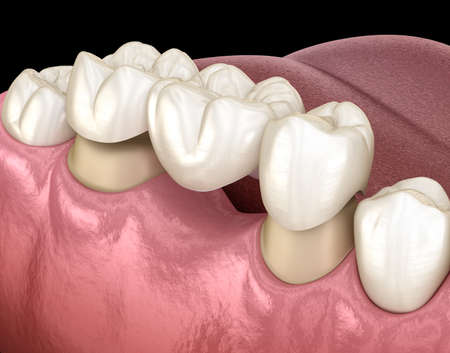 Dental bridge of 3 teeth over molar and premolar. Medically accurate 3D illustration of human teeth treatmentの写真素材