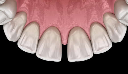 Diastema of central incisors teeth. Dental disfunction 3D illustration concept