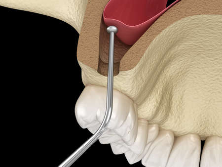 Sinus Lift Surgery - Sinus Augmentation. 3D illustrationの写真素材