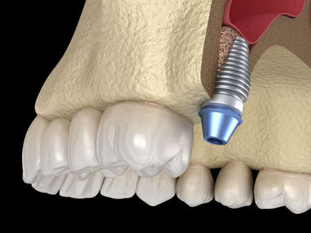 Sinus Lift Surgery - implant installation. 3D illustration