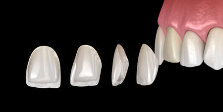 Veneer installation procedure over central incisor and lateral incisor. Medically accurate tooth 3D illustrationの写真素材