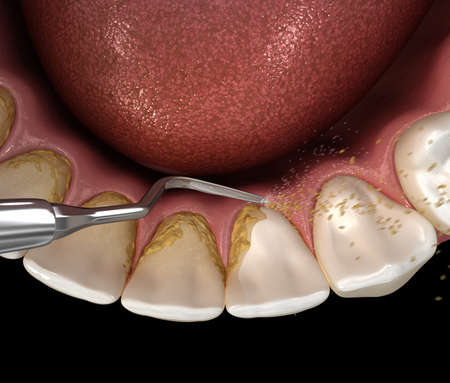 Oral hygiene: Ultrasonic teeth cleaning machine removing calculus and plaque. Medically accurate 3D illustration of human teeth treatmentの写真素材