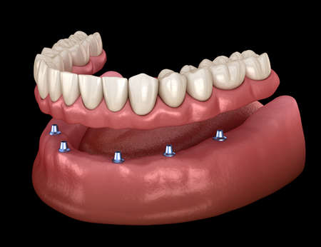 Mandibular removable prosthesis All on 6 system supported by implants.  Medically accurate 3D illustration of human teeth and dentures conceptの写真素材