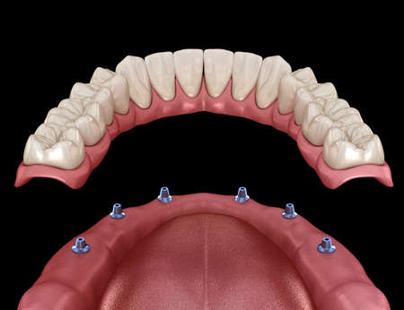Mandibular removable prosthesis All on 6 system supported by implants.  Medically accurate 3D...