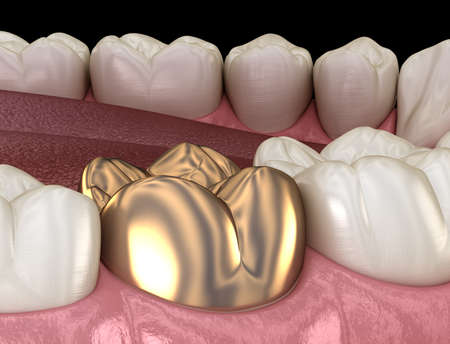 Golden crown molar tooth assembly process. Medically accurate 3D illustration of human teeth...
