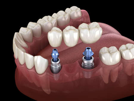 Dental bridge supported by implants. Medically accurate 3D illustration of human teeth and dentures...