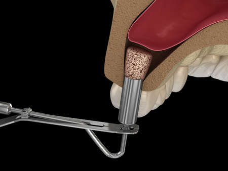 Sinus Lift Surgery - Adding new bone. 3D illustration